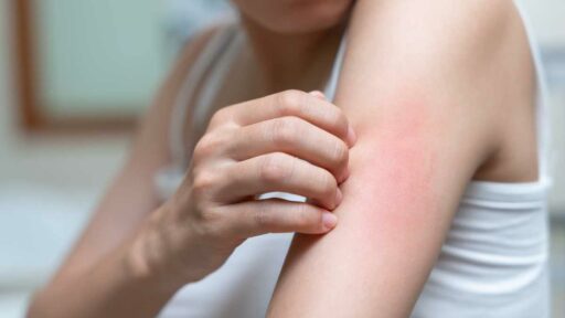 skin problem and beauty. Young woman scratch body has rash itchy skin