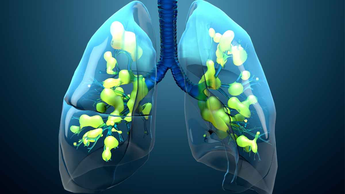 Polmonite - illustrazione con aree di infezione
