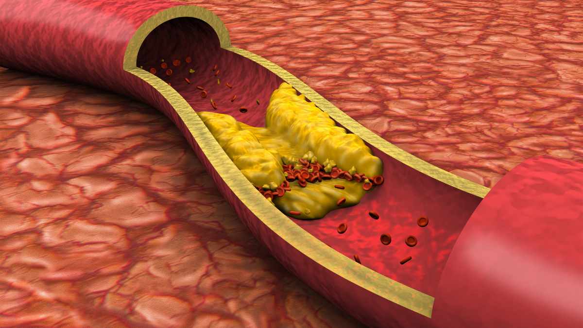 Cosa succede se si smette di prendere la pastiglia per il colesterolo?