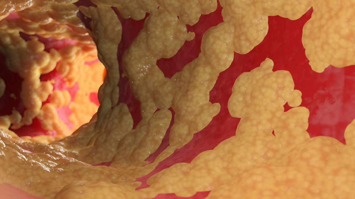 Qual è il farmaco migliore per abbassare il colesterolo?