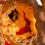 parete di vaso sanguigno coperto dal colesterolo