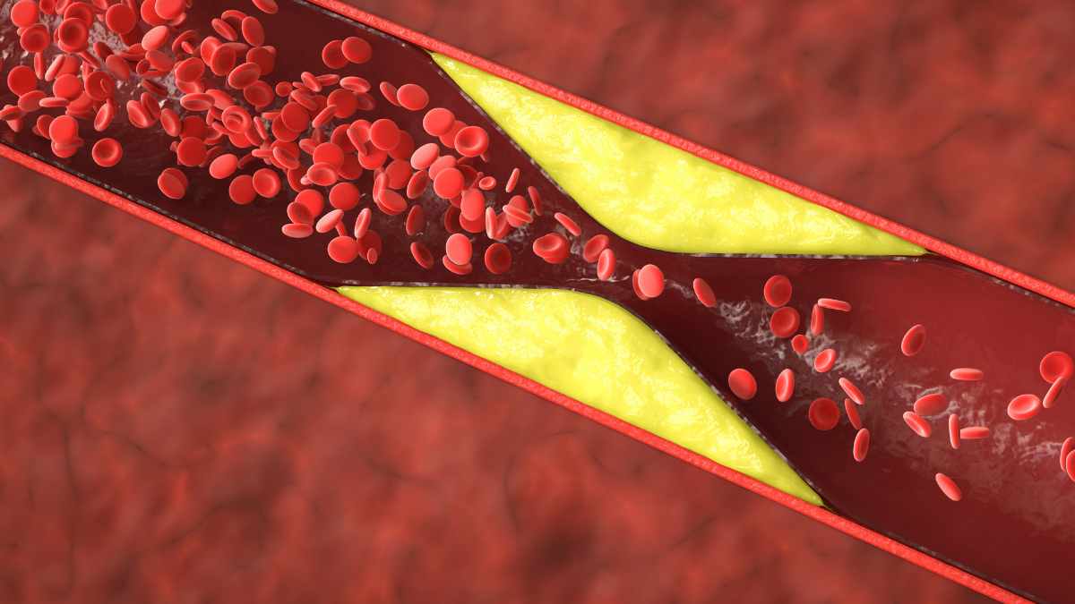 Come abbassare colesterolo glicemia e trigliceridi?