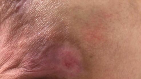 Cos’è la fibrina nelle piaghe?