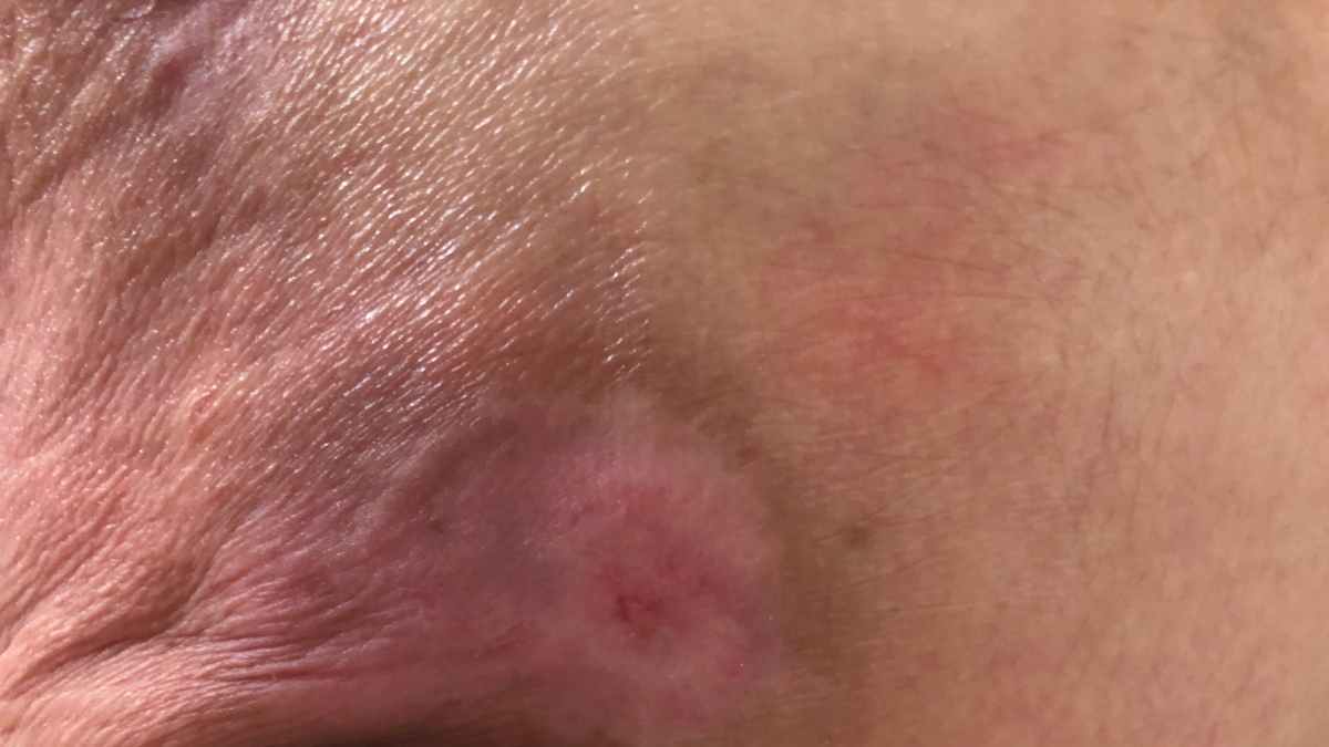 Cos’è la fibrina nelle piaghe?