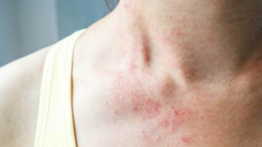 eczema al collo