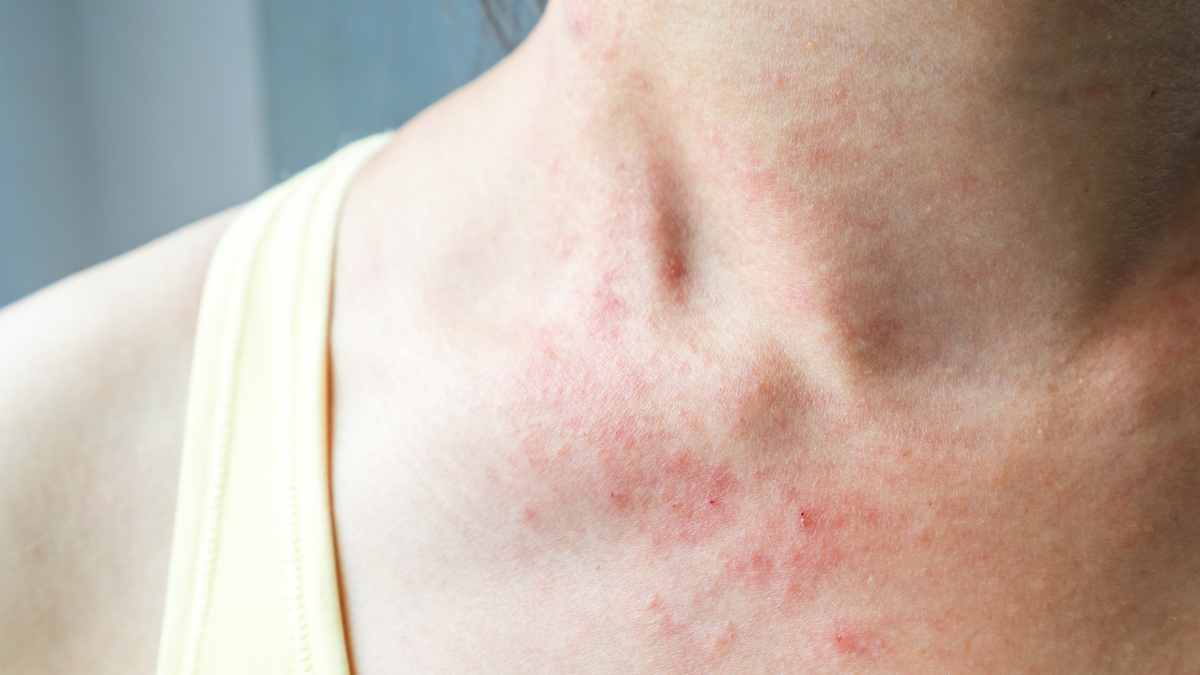 Come si presenta un eczema della pelle?