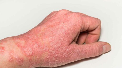 forte eczema a una mano