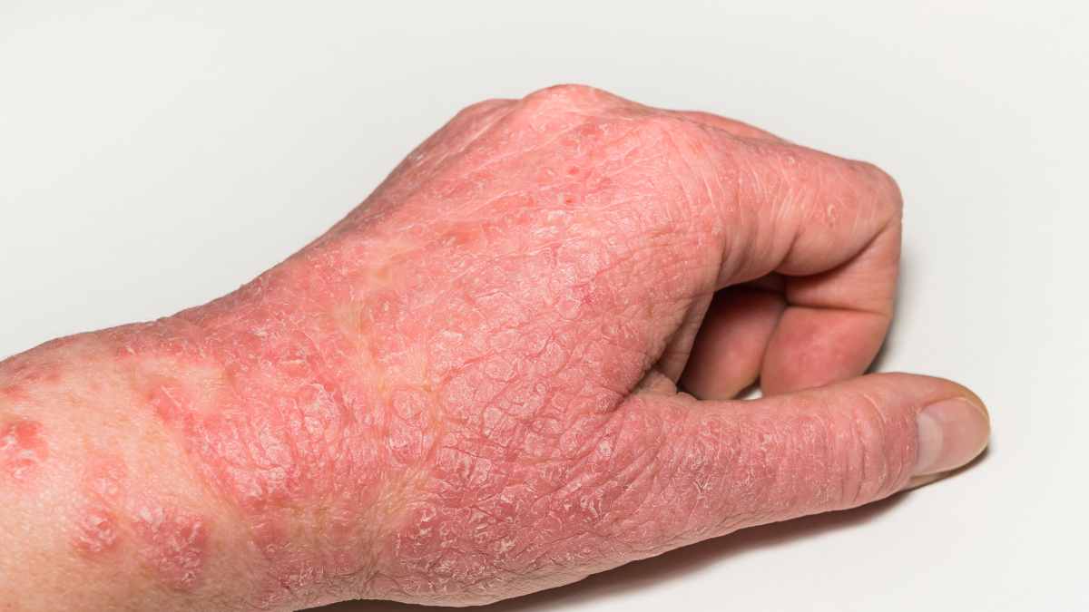 Quanto ci mette un eczema a guarire?