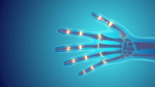 infiammazione a giunture che può essere curata con farmaci antinfiammatori