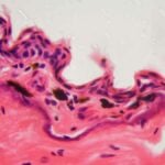 particolare di ulcera ingrandita al microscopio