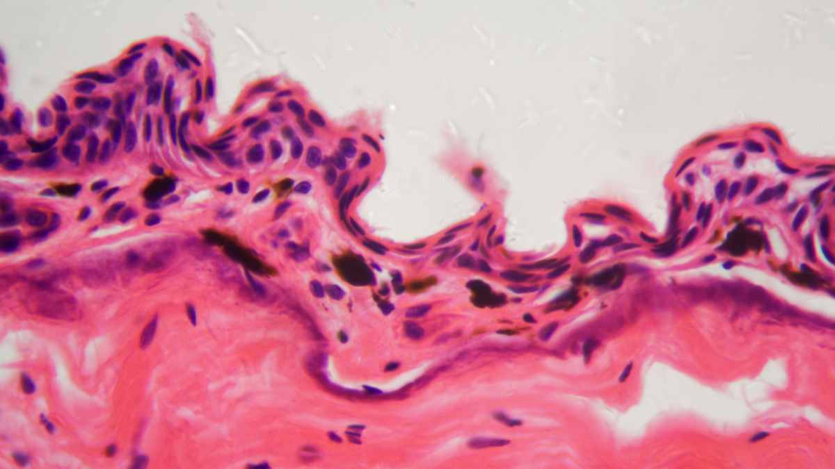 particolare di ulcera ingrandita al microscopio