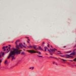 ulcera al microscopio