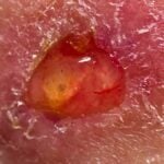 ulcera - focus ingrandimento