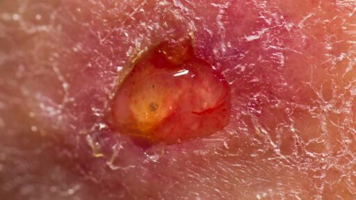 ulcera - focus ingrandimento
