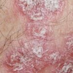 Dermatiti autoimmuni