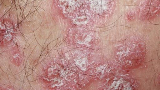 Dermatiti autoimmuni