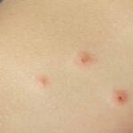 Dermatiti infettive
