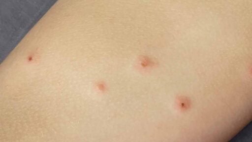 Dermatiti infettive