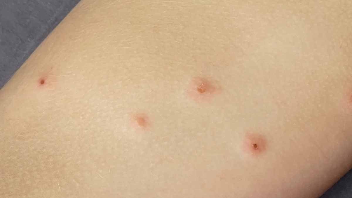 Dermatiti infettive