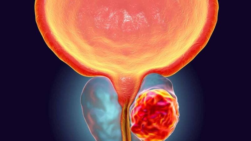 Prostata, Prostatite