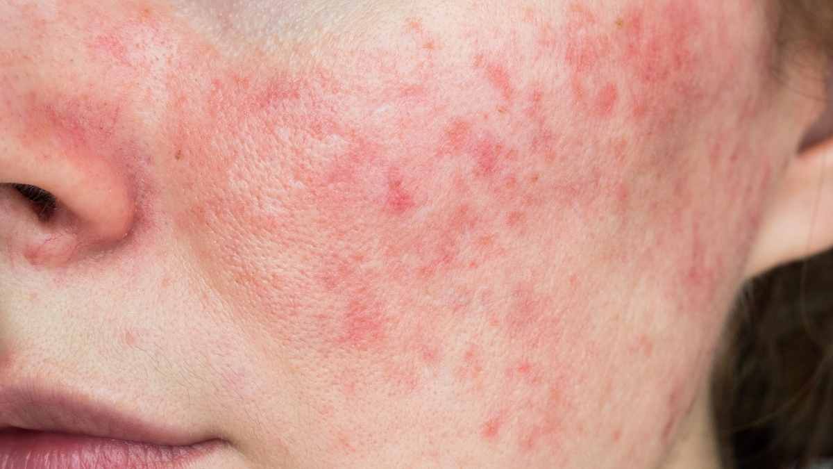 Rosacea