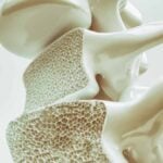 osteoporosi