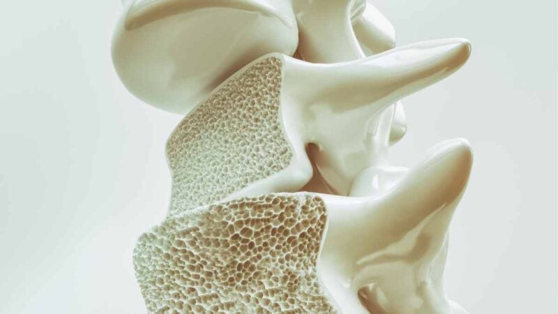 osteoporosi