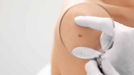 Analisi di un neo in reparto di Dermatologia