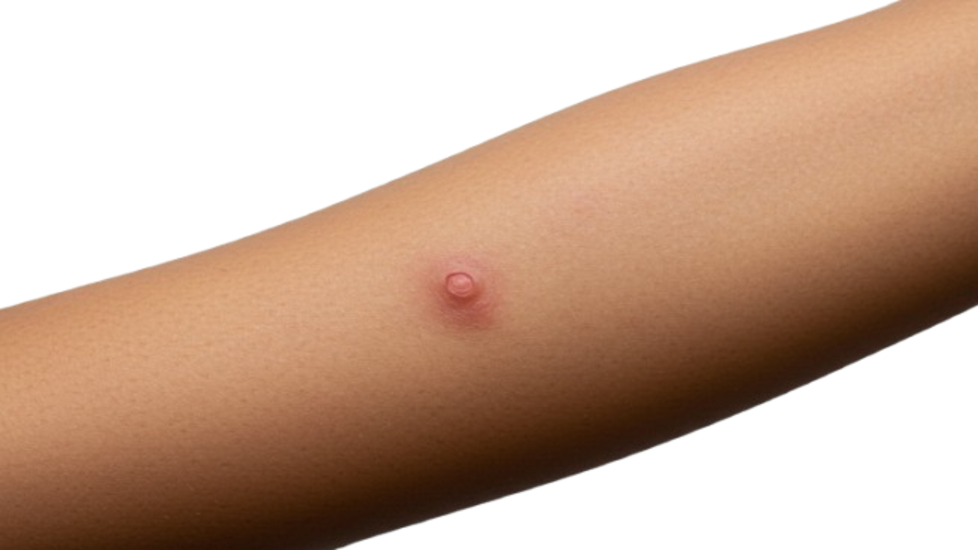 melanoma-acrale-lentigginoso-forma-rara-di-melanoma