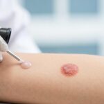 Carcinoma della pelle non melanoma: diagnosi e terapie