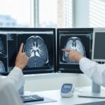 Fibrosi polmonare idiopatica: nuove prospettive terapeutiche