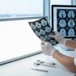 Qual è una malattia neurodegenerativa rara?