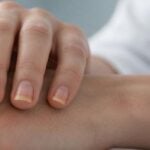 Sindrome delle unghie gialle: caratteristiche rare