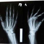 Osteoporosi: cause, sintomi e prevenzione