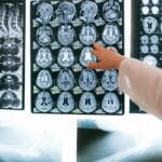 Morbo di Parkinson: Sintomi e Diagnosi