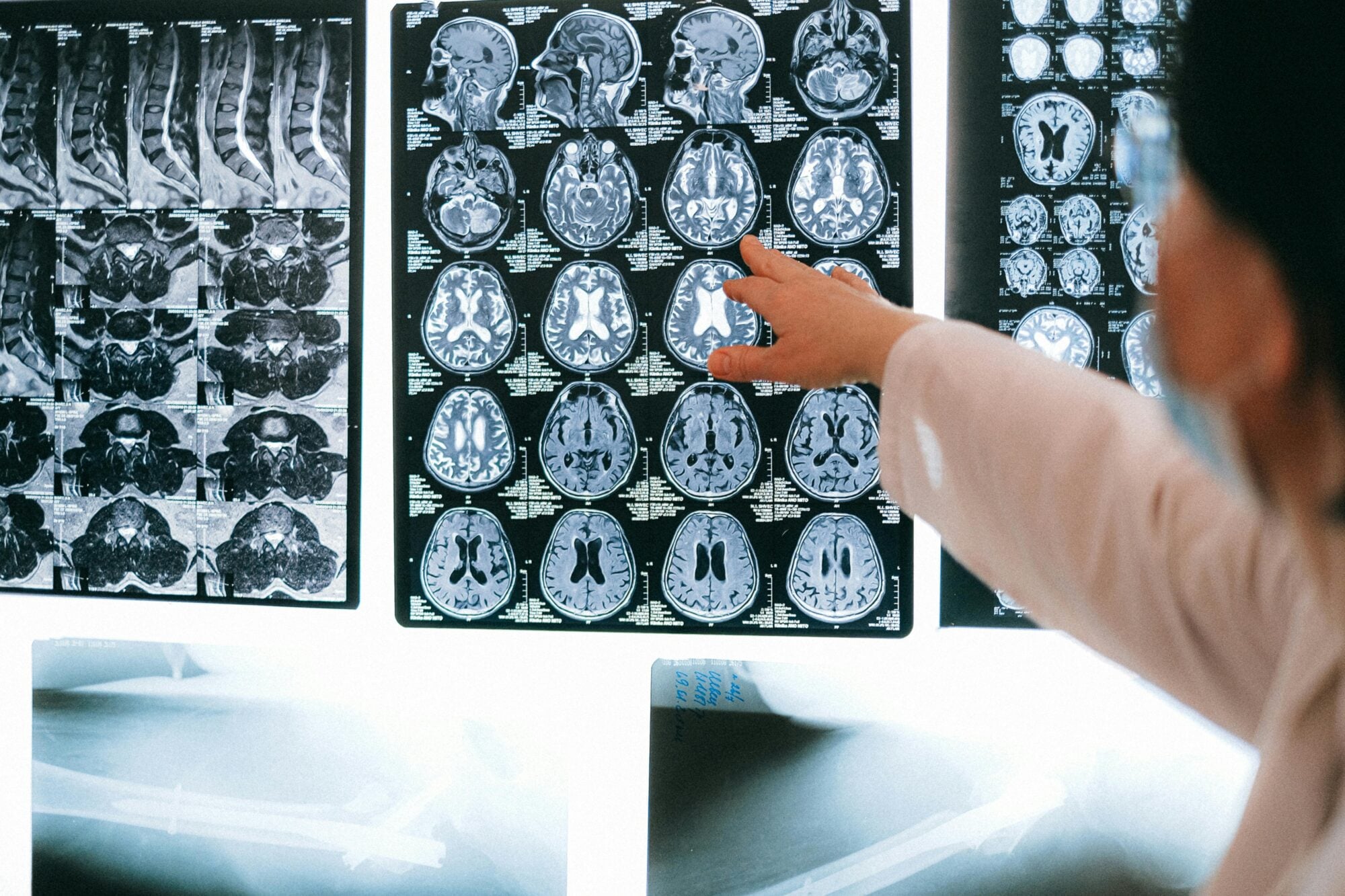 Morbo di Parkinson: Sintomi e Diagnosi