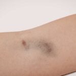 livido, ematoma, contusione