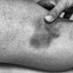 Quale pomata usare per gli strappi muscolari