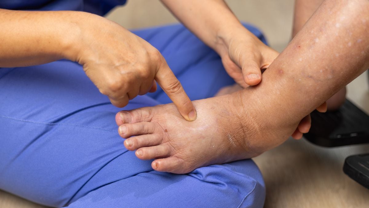 Quale pomata usare per il gonfiore alla caviglia