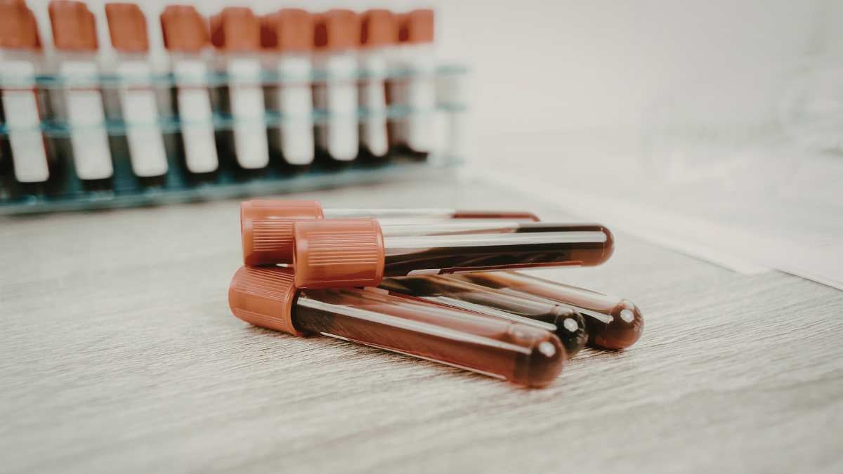 Che cos&rsquo;è la creatinina, perché si misura nel sangue e nelle urine e quali sono i valori normali