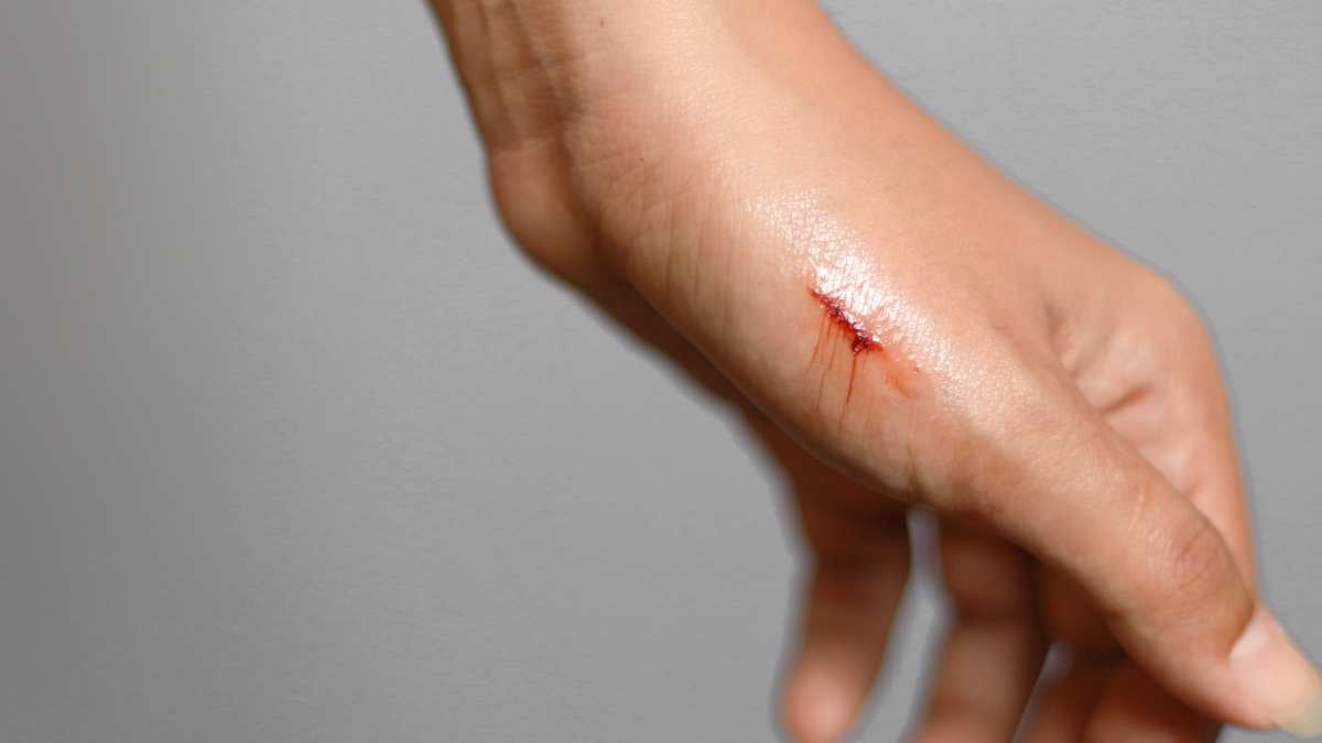 Come capire se un taglio ha fatto infezione