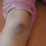 Come curare i lividi sulle gambe