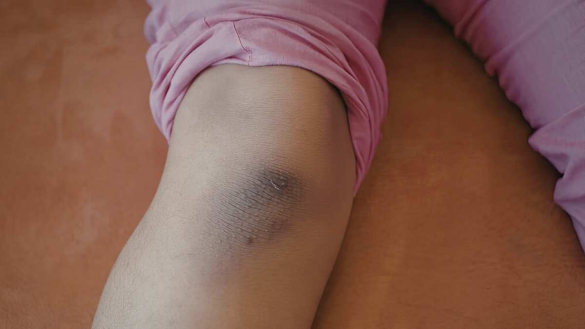 Come curare i lividi sulle gambe