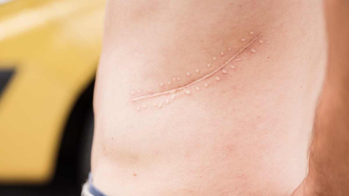 Come riempire una cicatrice infossata