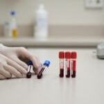 Decadron a medio-lungo termine: quali esami di controllo servono?