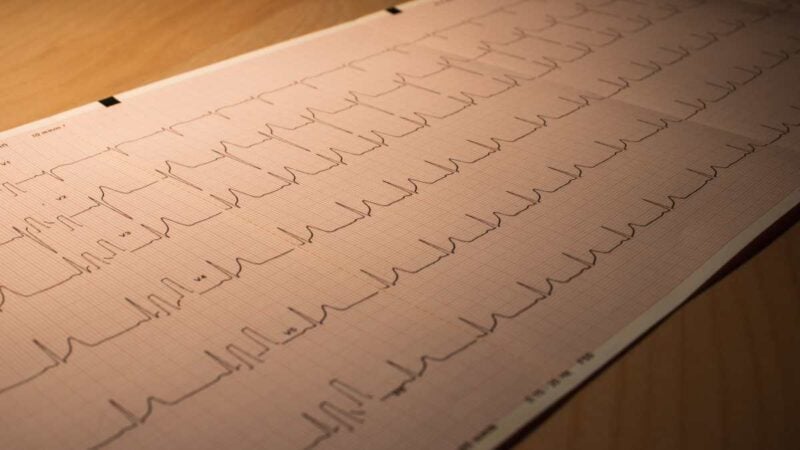 Chi ha avuto un infarto ha diritto alla pensione di invalidità