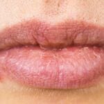 herpes labiale