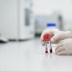 Insulinemia: che cos’è, valori normali, insulina bassa o alta e cosa significa