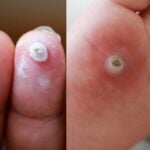 verruche mani e piedi