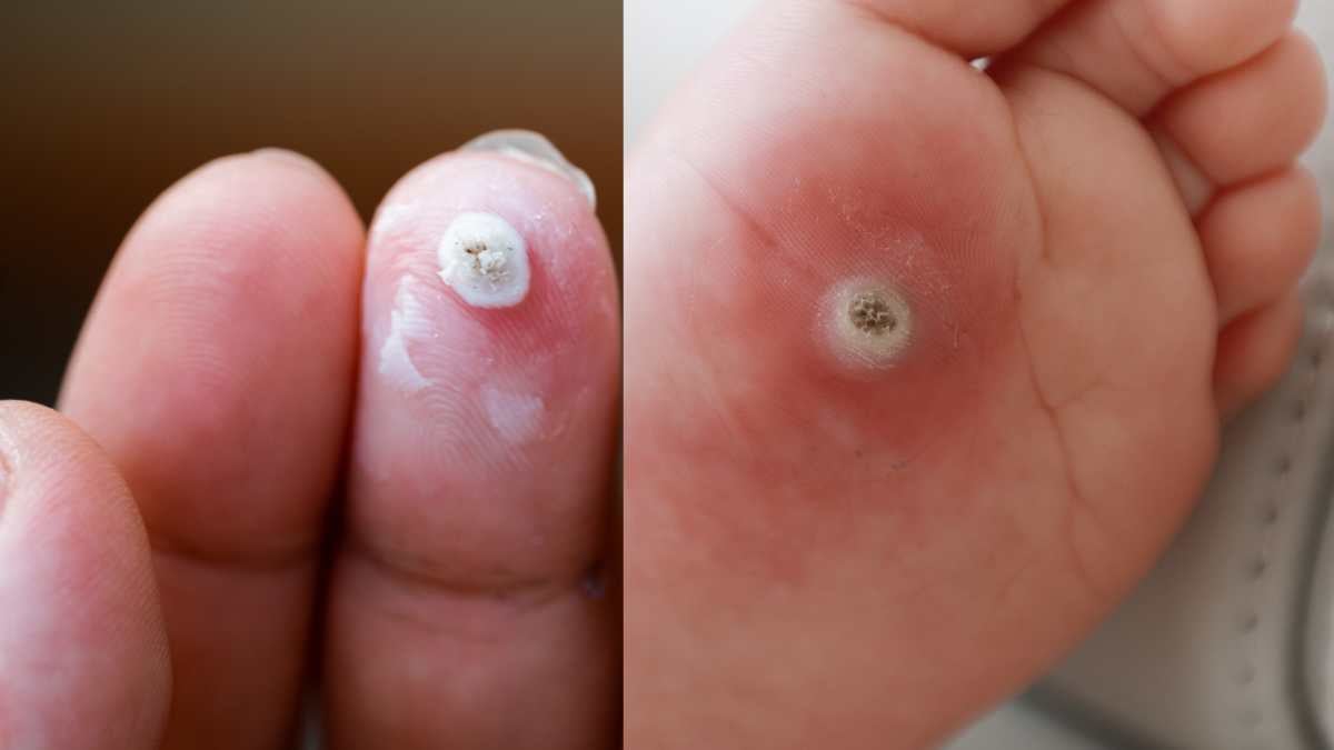 verruche mani e piedi